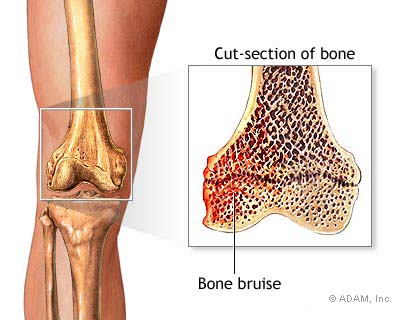 bone-bruise.jpg